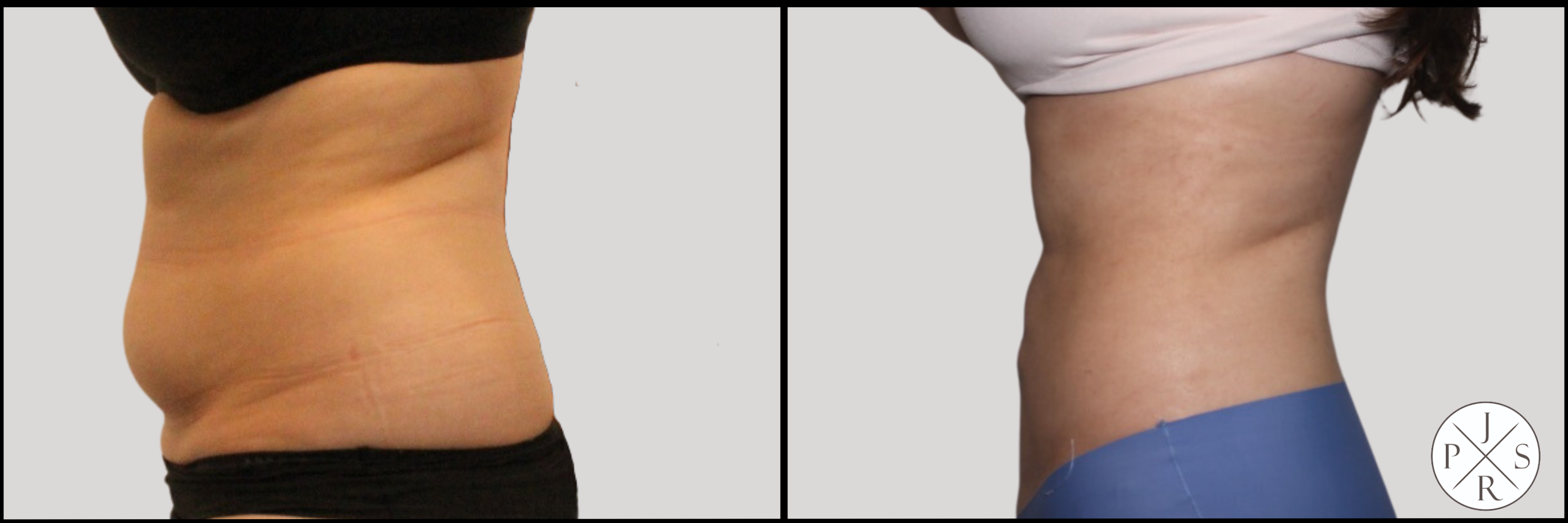 Liposuction Before & After Image